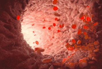 巨幼细胞性贫血的诊断标准，巨幼细胞性贫血严重吗